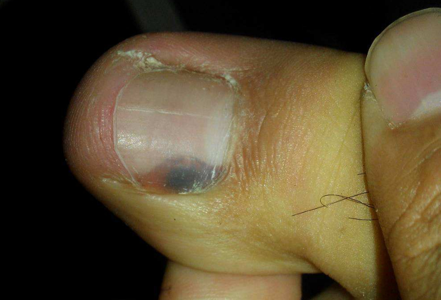 指甲变黑现在很多人特别是熬夜之后,眼睛就会出现黑眼圈.