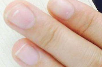 指甲发白或有白点是什么原因,它多见于这些疾病!