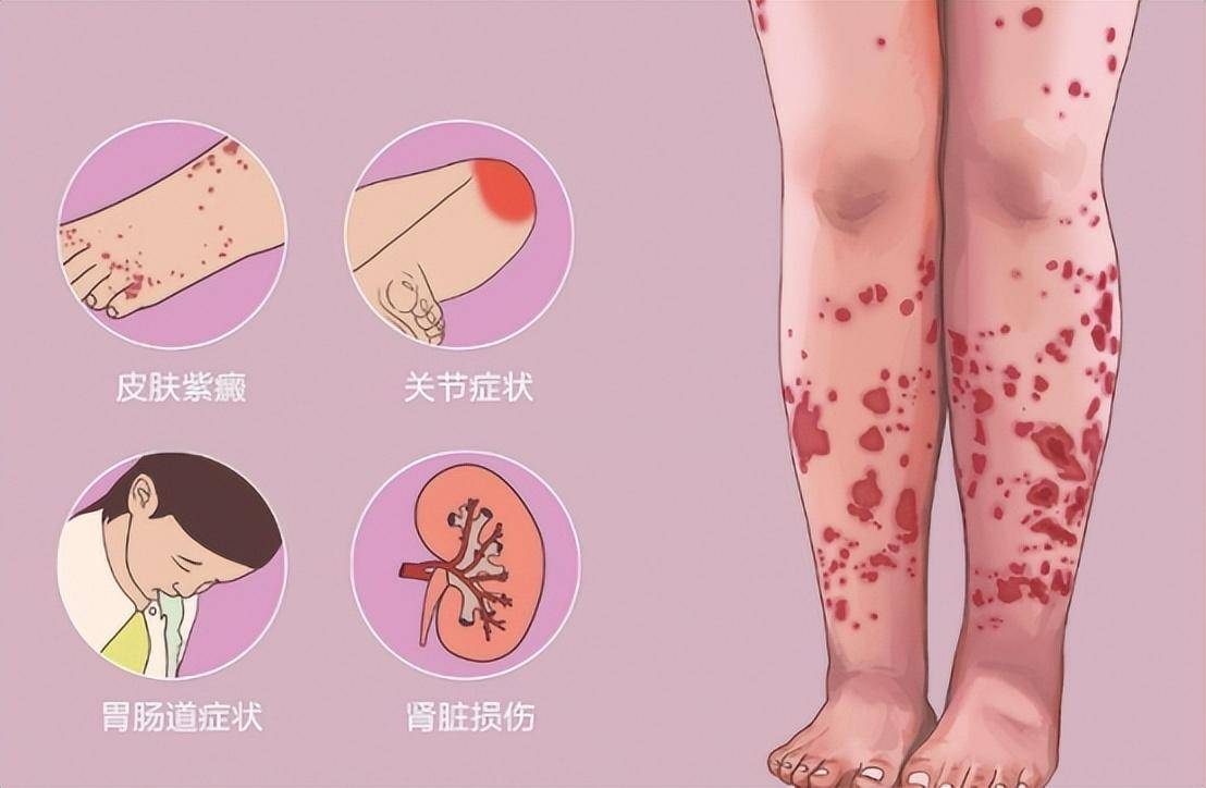 一种较常见的皮下出血性疾病,因皮肤黏膜或脏器出血而形成的皮肤淤血