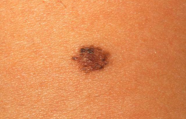 痣人人都有,但这4种痣最好去点掉,尤其是长在私处的痣