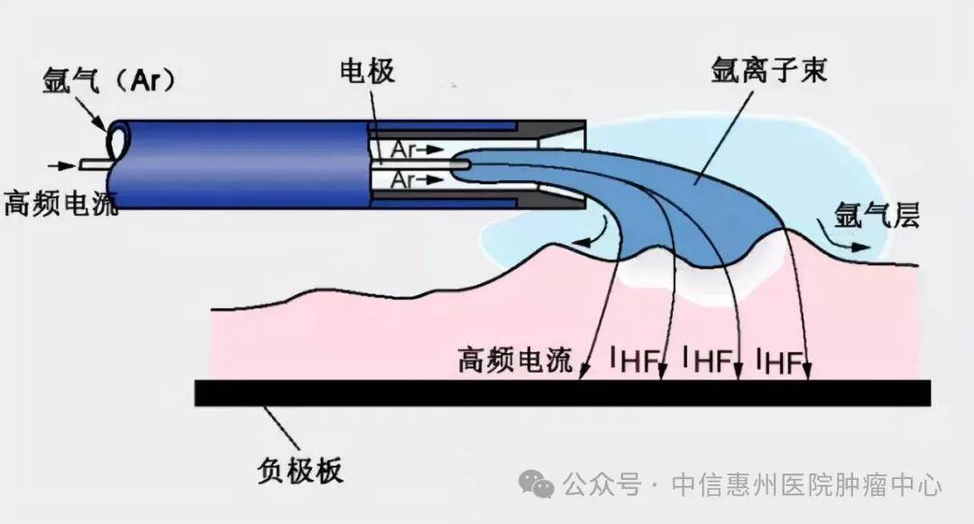 一针"冻死"癌细胞,揭秘氩氦刀冷冻消融术—损伤小