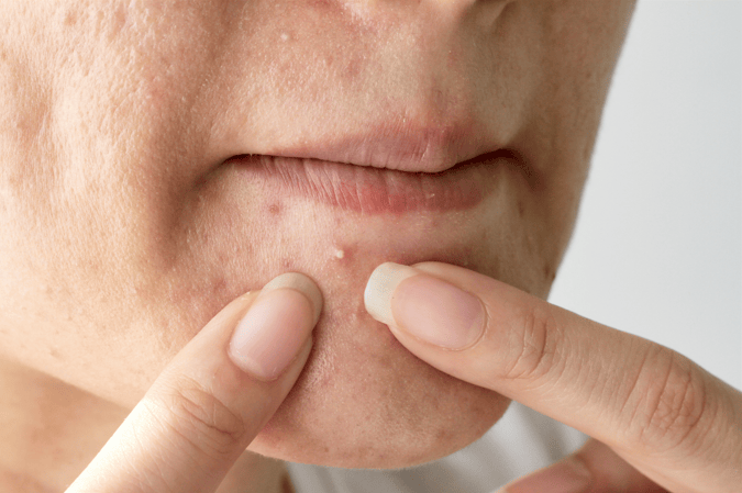 痘等都是痤疮的俗称,是一种发生在毛囊皮脂腺单位的慢性炎症性皮肤病