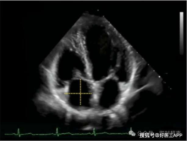 床旁超声心动图的基本测量