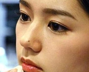 脸上痣的位置与命运:脸上痣长哪最有福气?