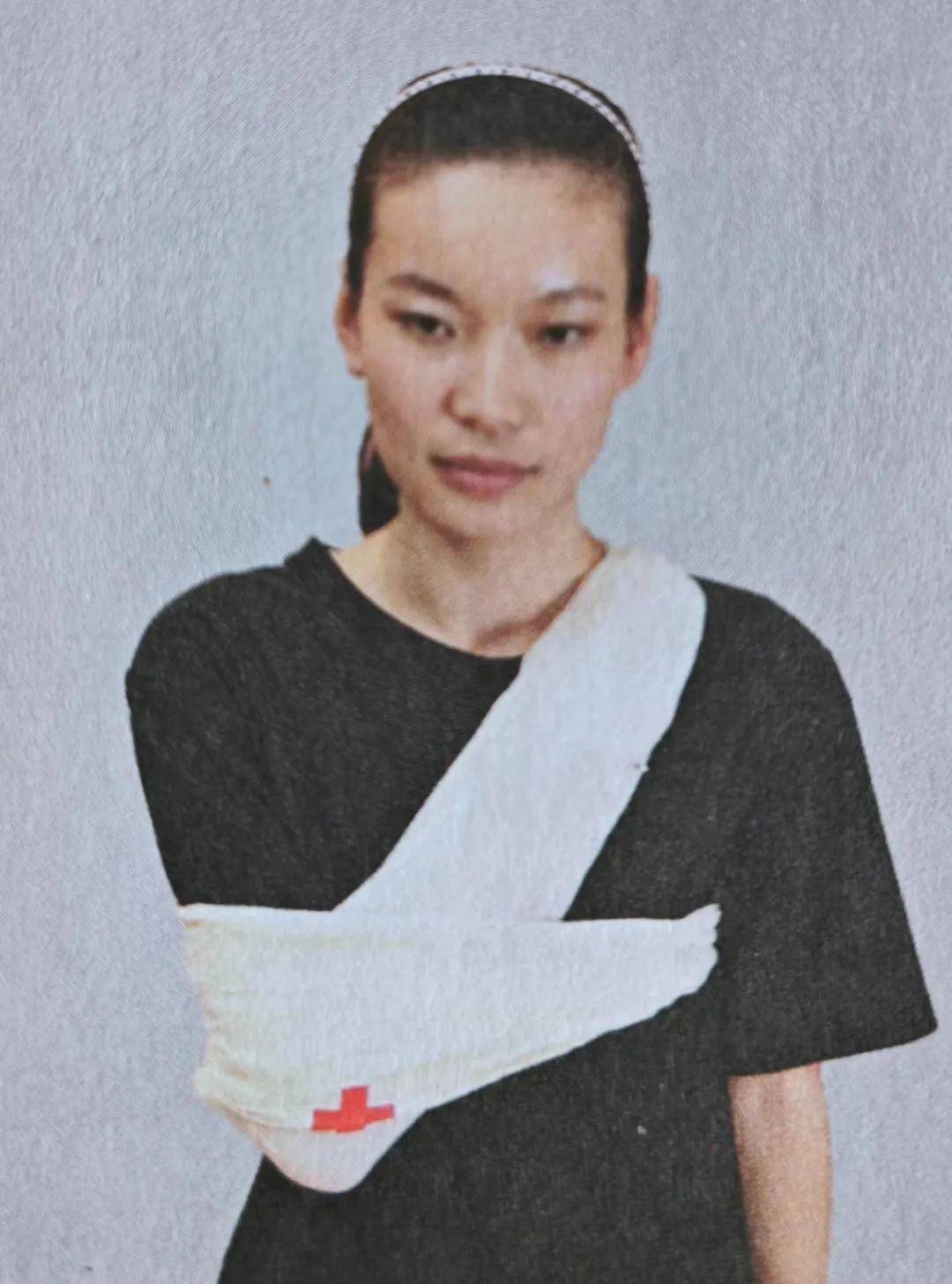 骨折固定有哪些方法