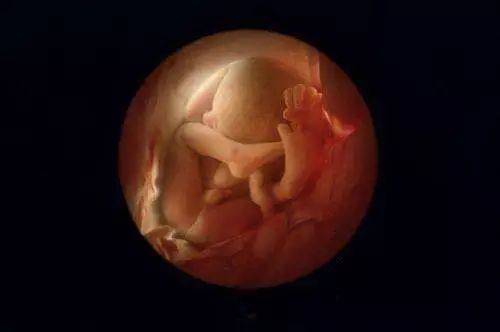水银中毒的胎儿图片