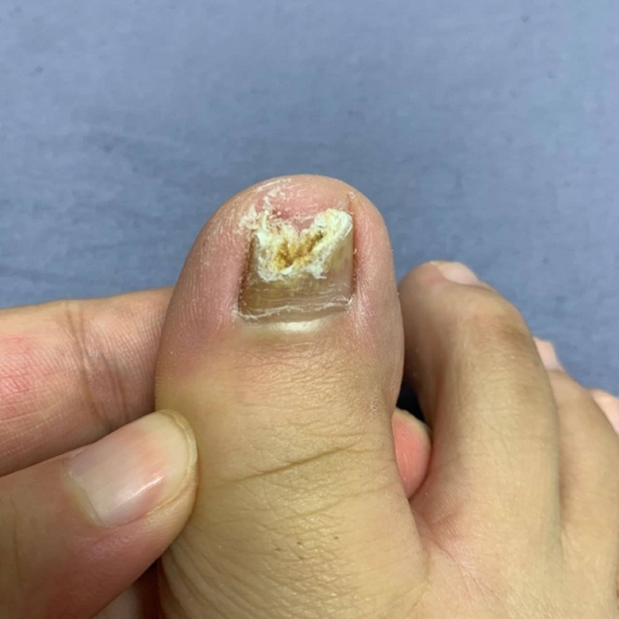  /strong>为大家 strong>详细说明治疗灰指甲的方法和步骤 /strong>