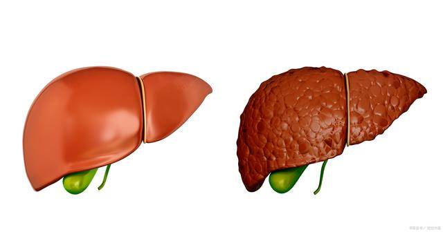 人体的脂肪肝真实图片图片