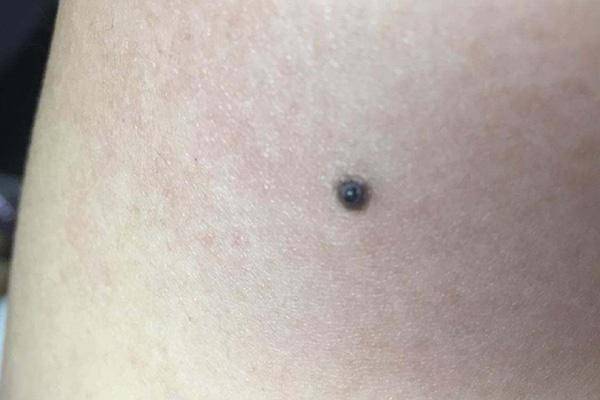 良性的色素痣,一般它的边缘是比较整齐的,大笑均匀,而恶性黑色素瘤,它