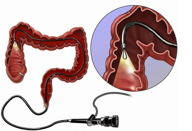 肠镜管子多粗多长图片图片