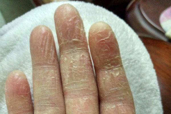 手上有它赶紧去医院危害太大了