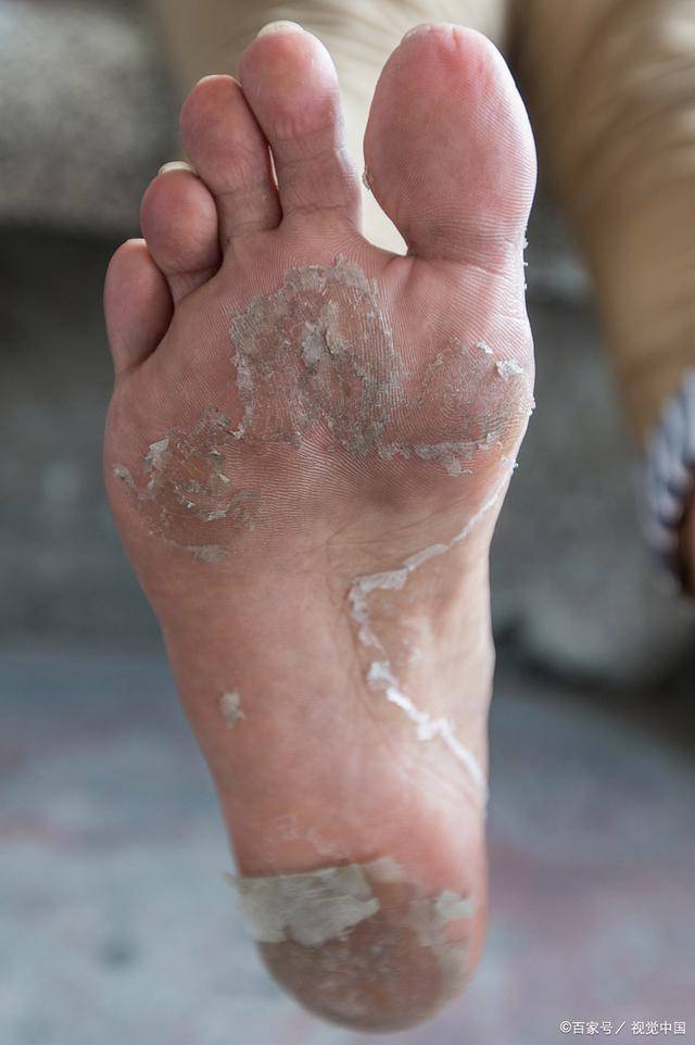 一,了解脚气真菌种类与特性:脚气真菌主要包括红色毛癣菌,须癣毛癣菌