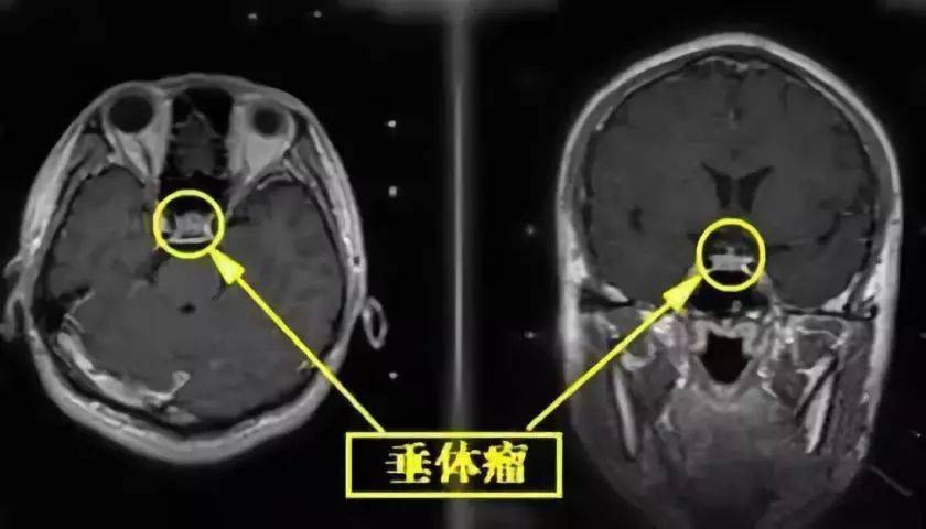 垂体瘤患者赴德国进行质子治疗【携康就医指南】垂体瘤出国治病