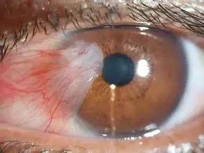 对结膜及角膜的伤害白内障是由于晶状体硬化,浑浊而导致的眼部疾病