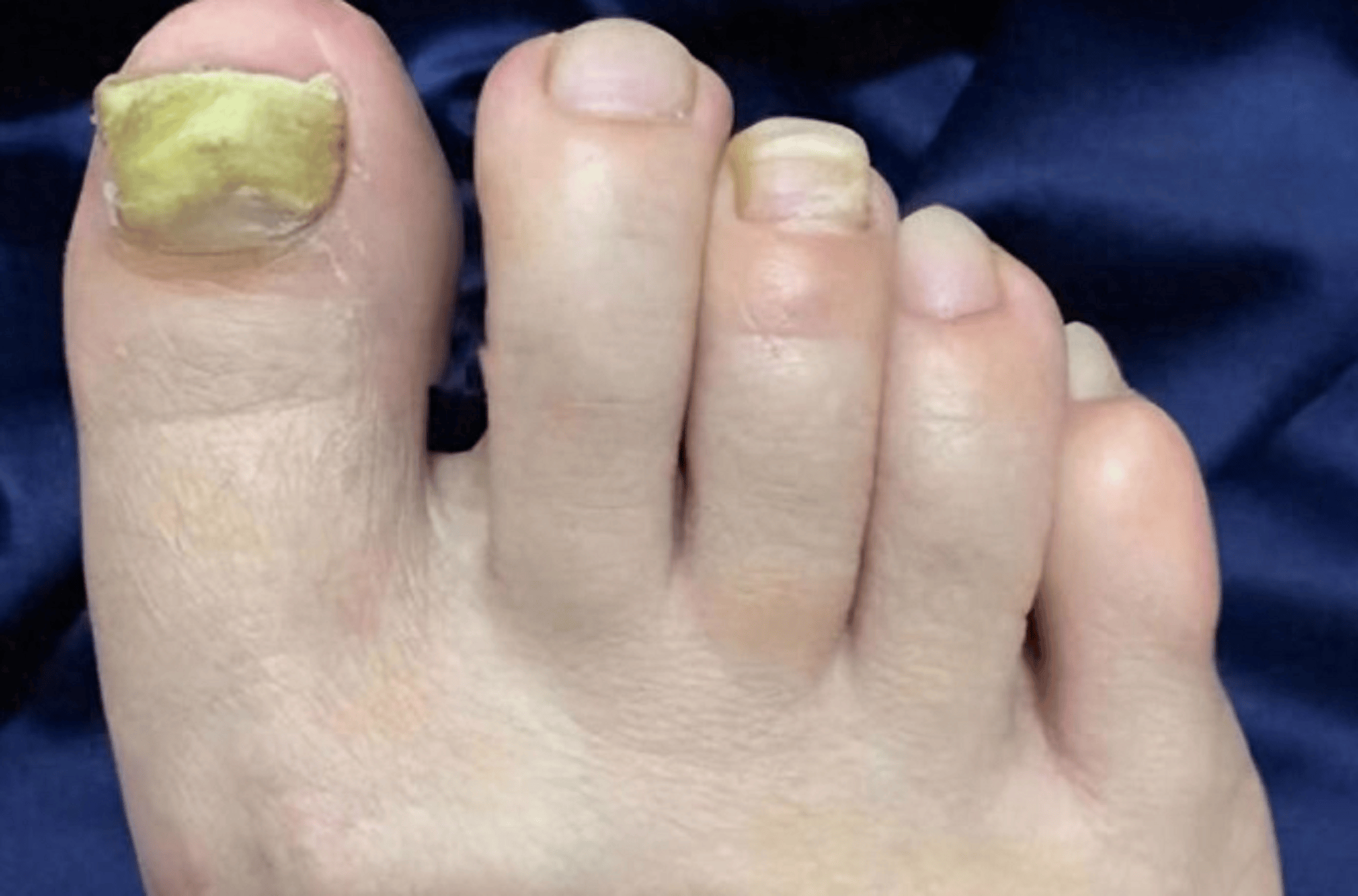 灰趾甲别乱用偏方了!这个步骤跟着做,真菌在家根除!