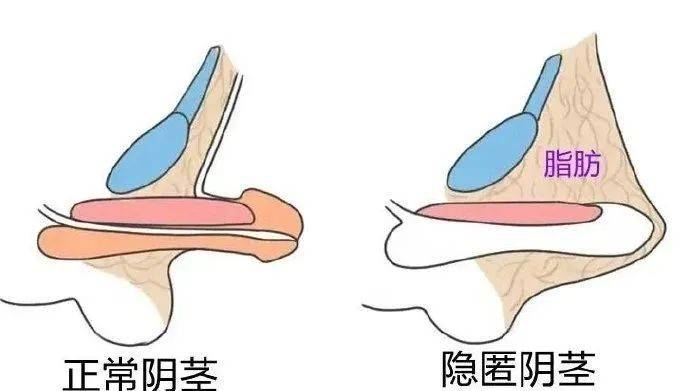 隐匿性阴茎vs包茎:一文教你如何区分