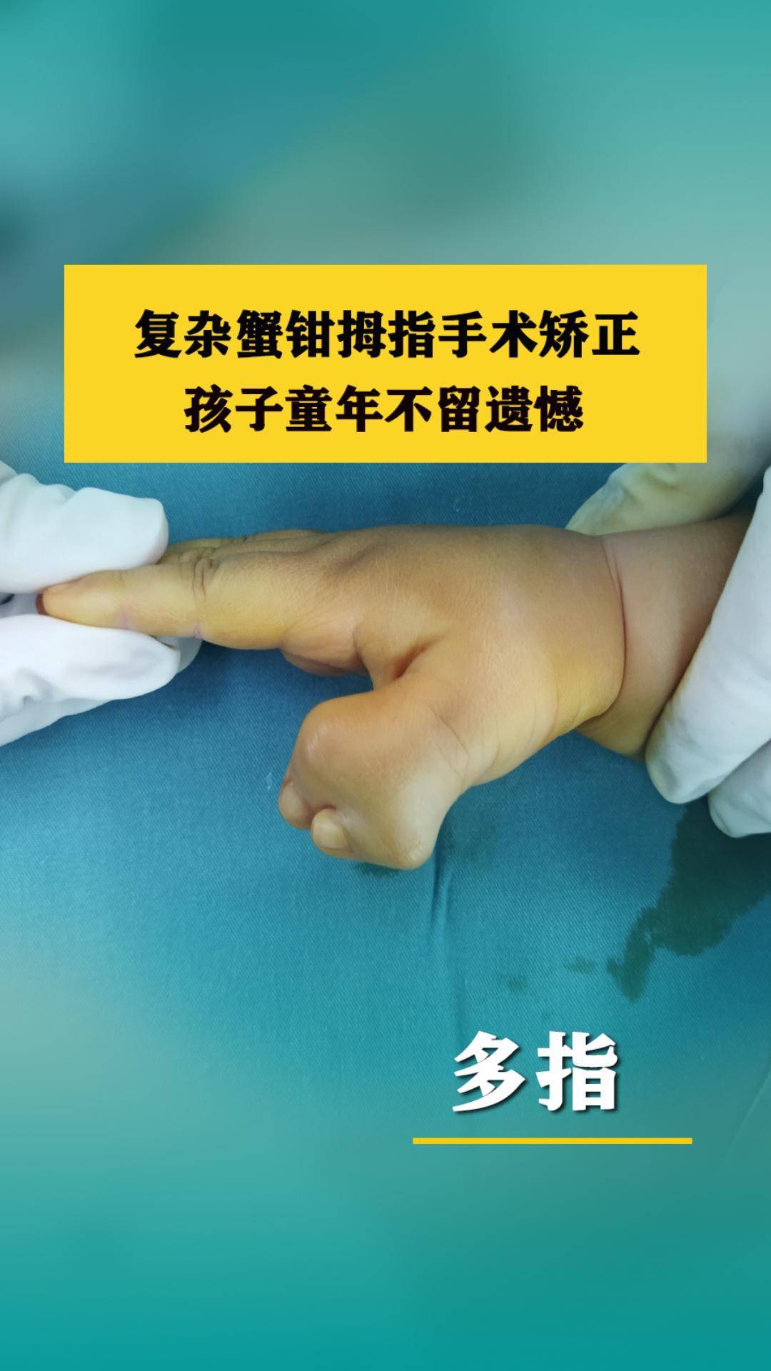 复杂蟹钳拇指手术矫正,孩子童年不留遗憾