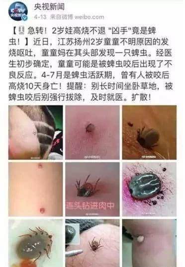 被家长发现5岁男童的腋窝下有蜱虫死死的咬住,因为虫子的一半身体已经