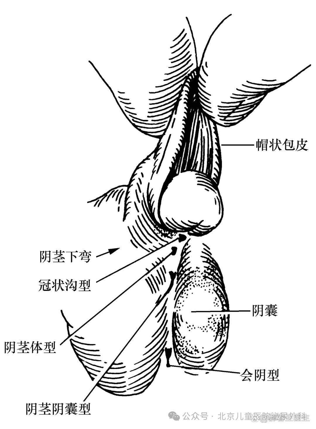 其一为尿道开口位置异常,即尿道开口异位于正常尿道口近端阴茎腹侧的