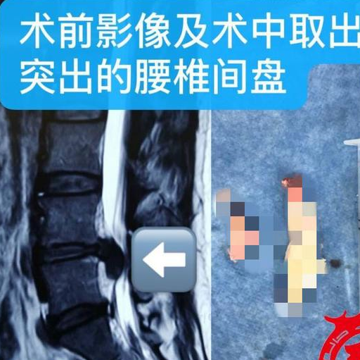一听要手术,陈女士一下子没了主意.