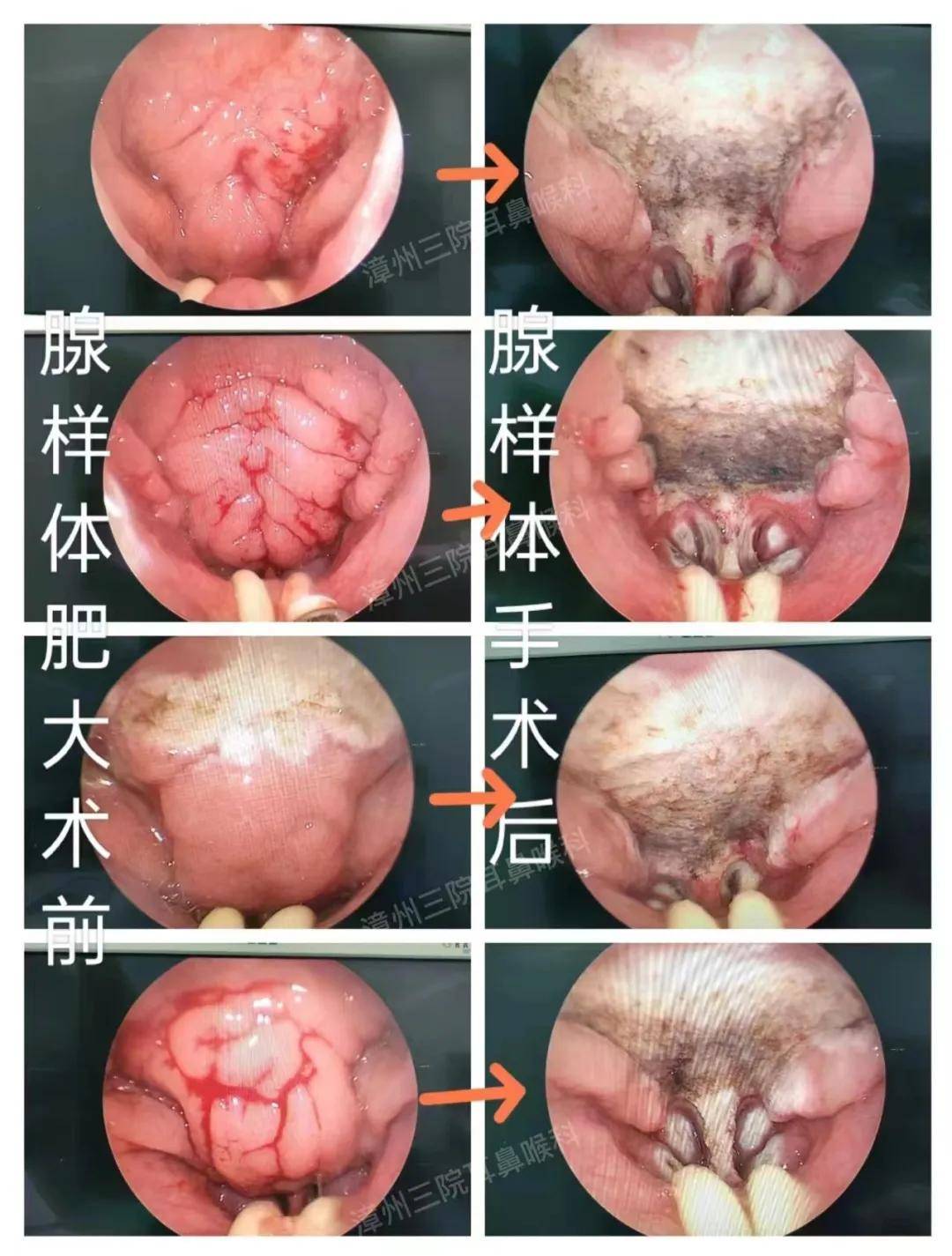 儿童扁桃体切除术图片