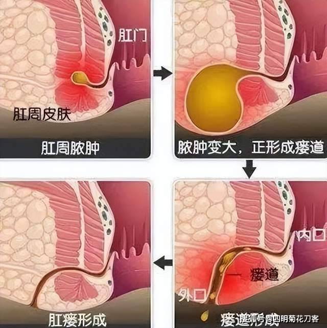 肛门到直肠的距离图片