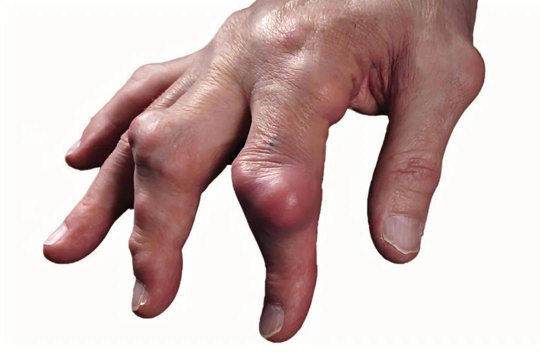 痛风专家黄川云解答!