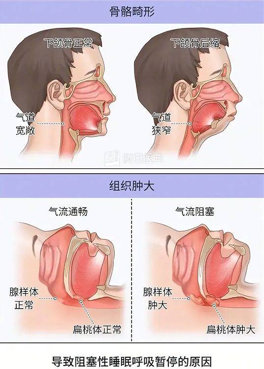 扁桃体肥大的原因图片