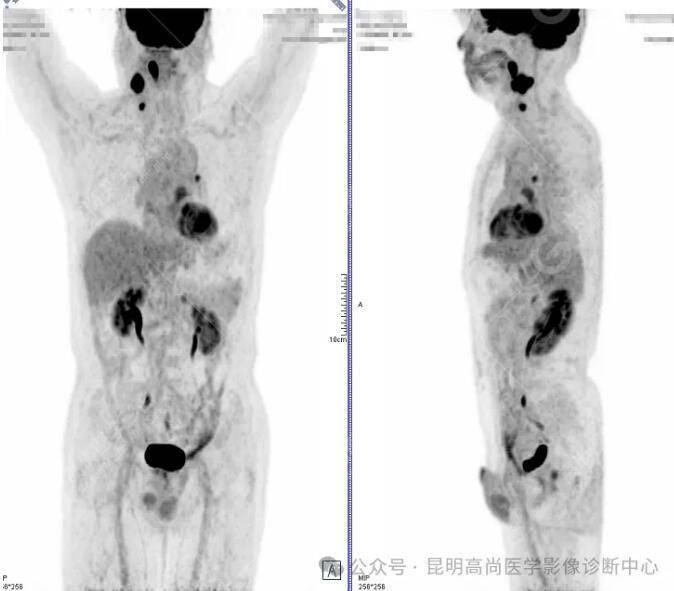男,69岁,PET/CT寻找原发灶一例_病变_肿瘤_淋巴结