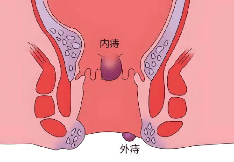 当痔疮闯入生活