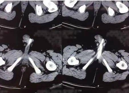 13岁男孩血尿医生取出20多颗磁力珠-13岁小孩尿血这是什么原因引起的