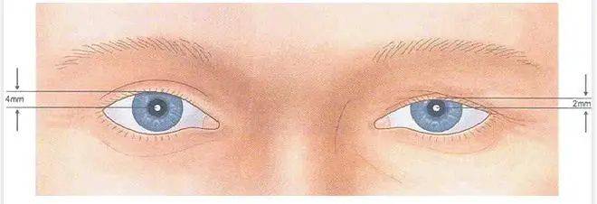 上眼睑下垂之后还能恢复吗?