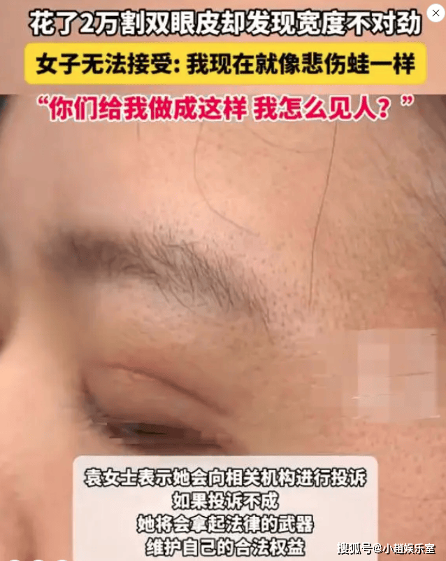 女子花2万割双眼皮控诉成了悲伤蛙,要求美容院退款遭拒