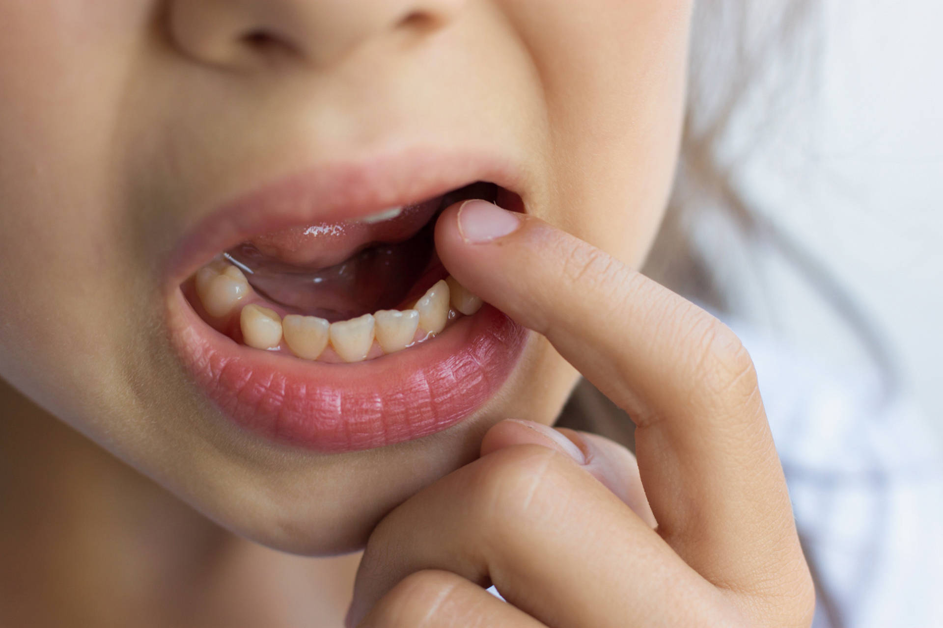 邢台种植专家:小孩牙齿松动怎么办?