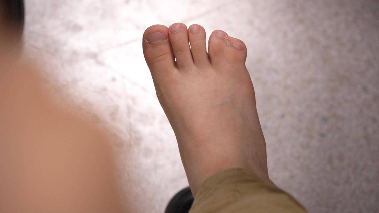 小女孩脚趾并在一起不美观,妈妈心里一直有疙瘩