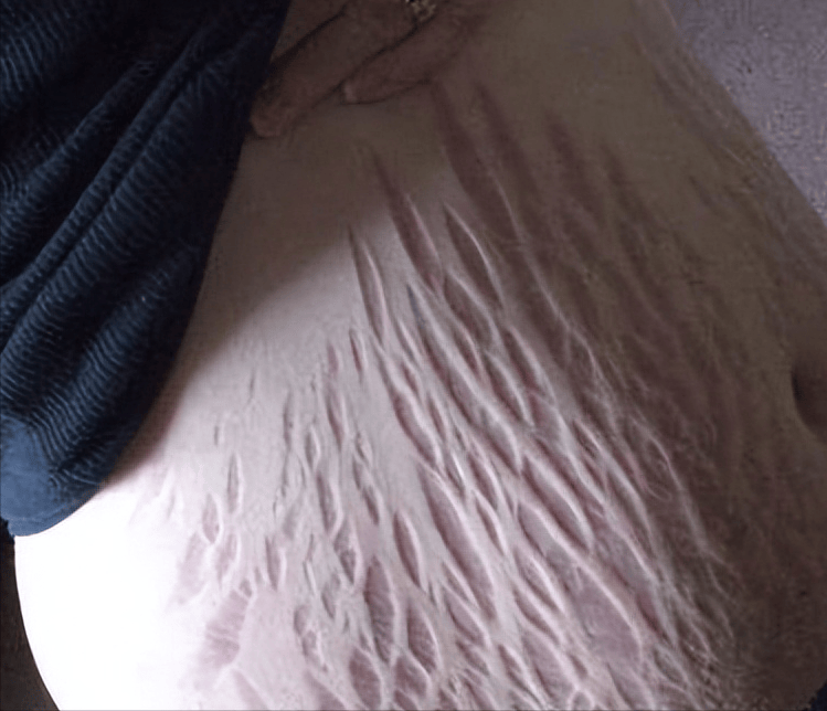 新婚发现妻子有妊娠纹,丈夫心生不满坚持要离婚,医生一番话释怀