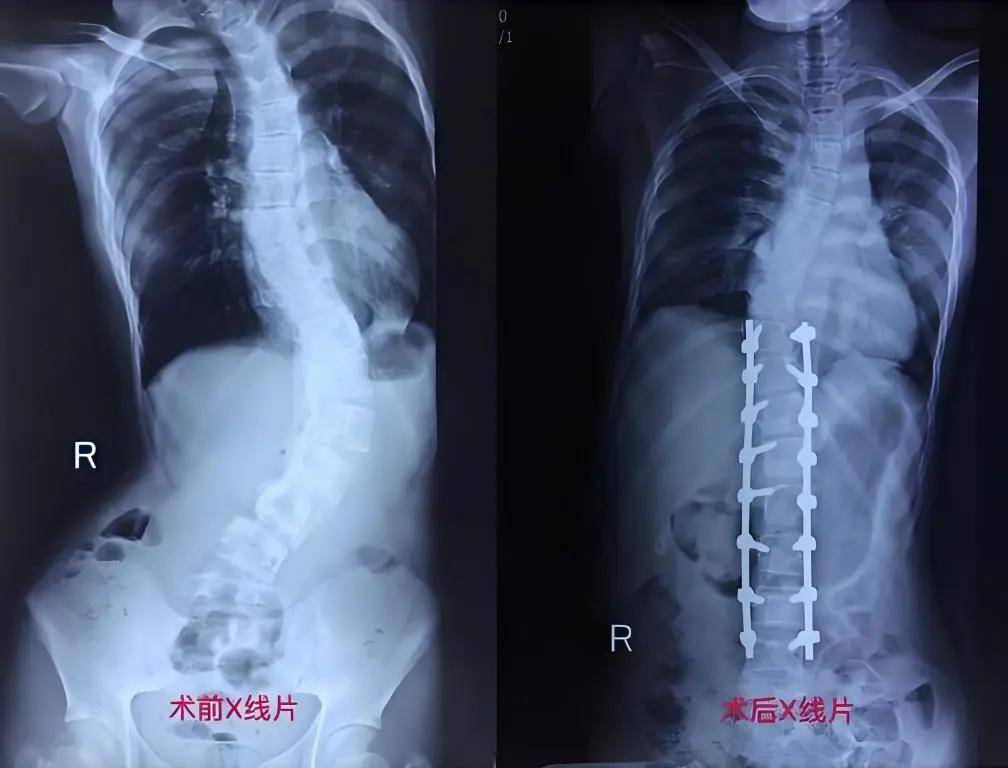 直乐正姿科普：什么是脊柱侧弯Cobb角呢？_支具_物理疗法_医生