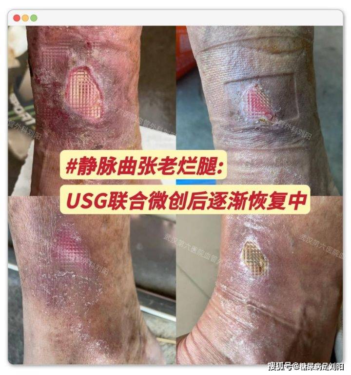 腿上的烤火斑能自愈吗图片