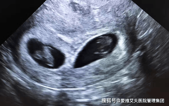 多囊卵巢综合征更容易怀双胞胎?听听天津爱维医院纪春艳怎么说