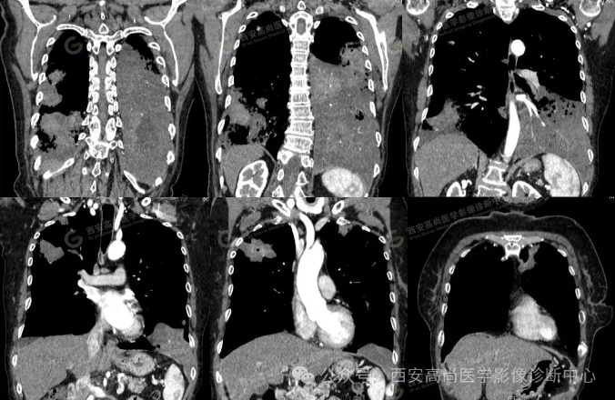 女,63岁,肺粘液腺癌一例