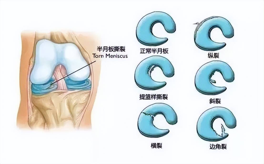 膝关节半月牙图片图片