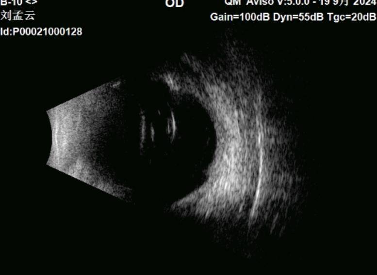 ,创伤性玻璃体疝,角膜板层裂伤,视网膜震荡,视力仅存