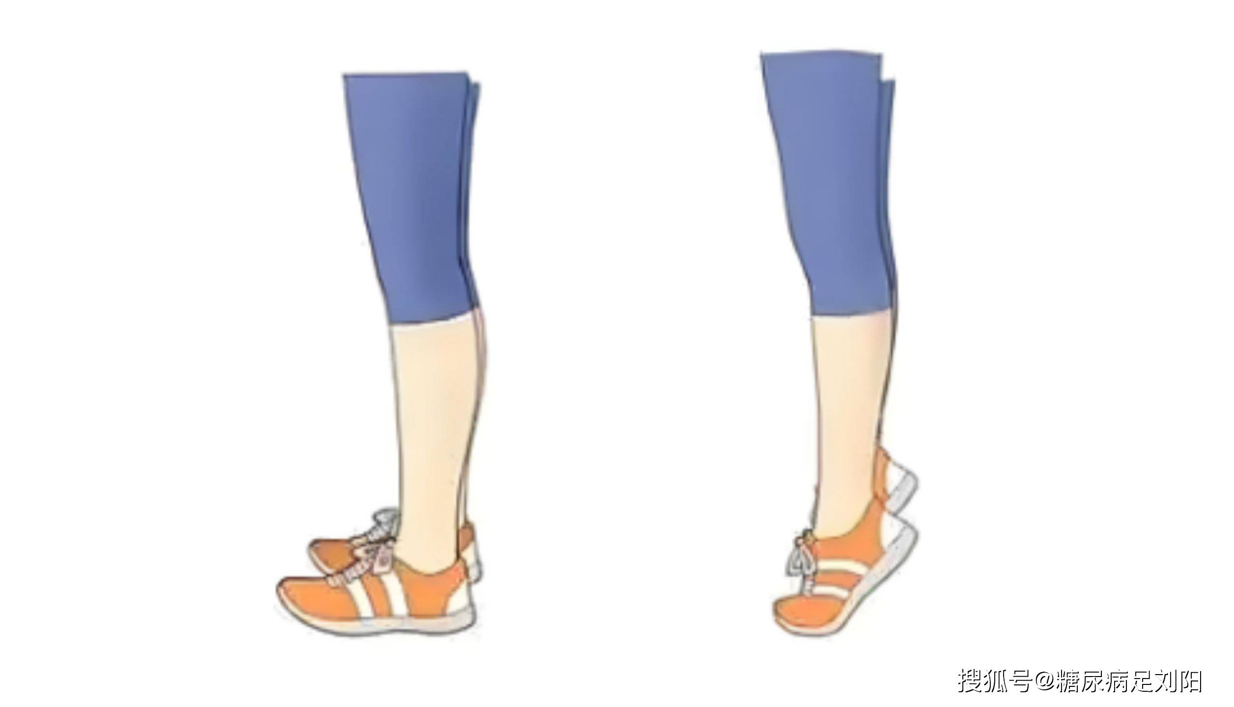 注意不要站立走动,可以借用轮椅辅助行走,避免因为活动诱发血栓脱落