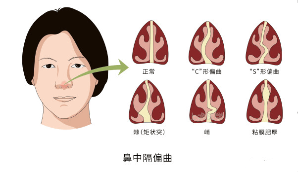 新生儿鼻腔狭窄图片