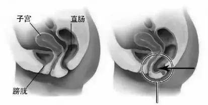 子宫直肠窝无回声区图片