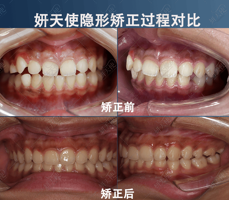 儿童颌骨矫正图片