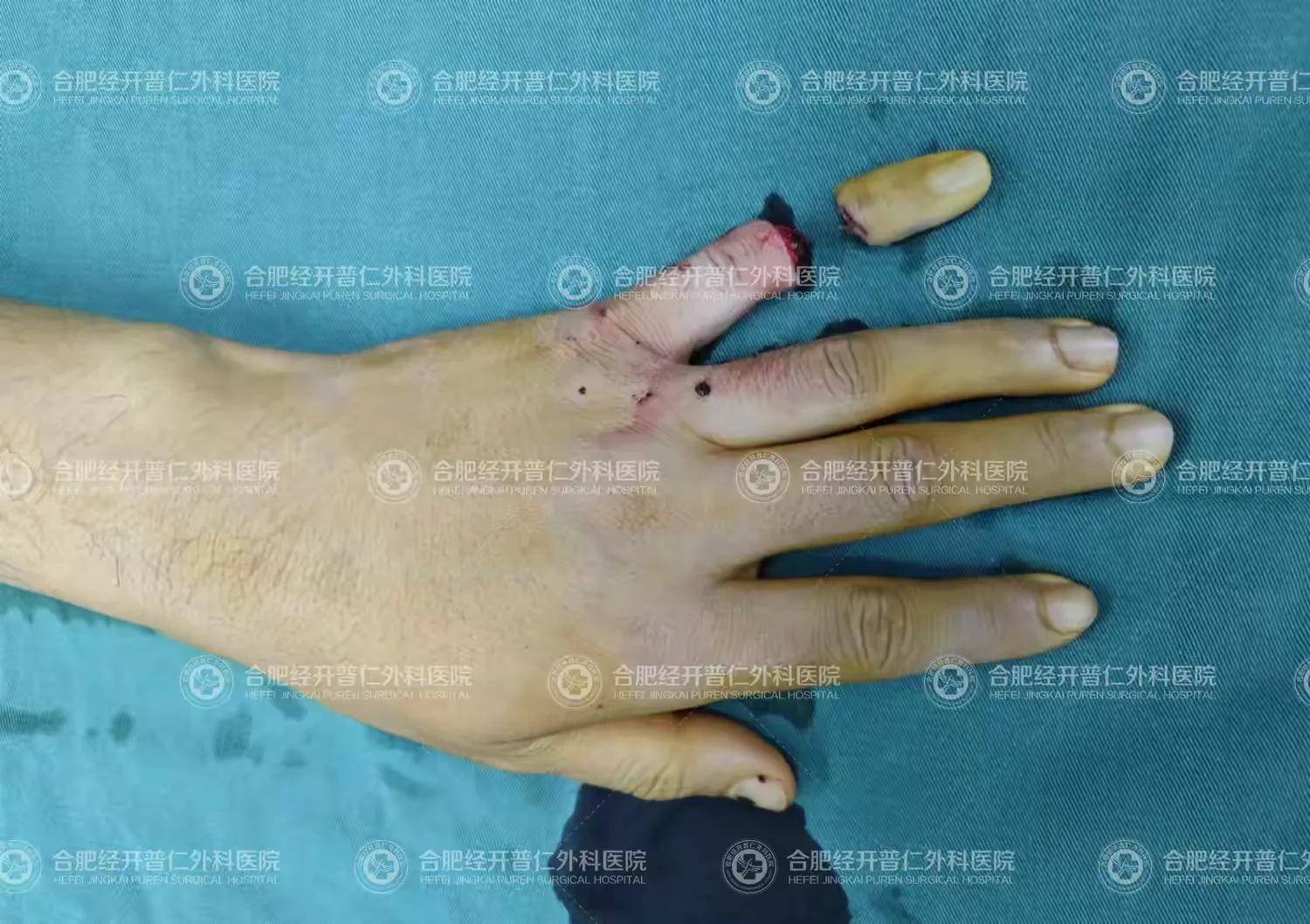 【手足外科】显微镜下的雕刻——断指再植,让手指重获新生!