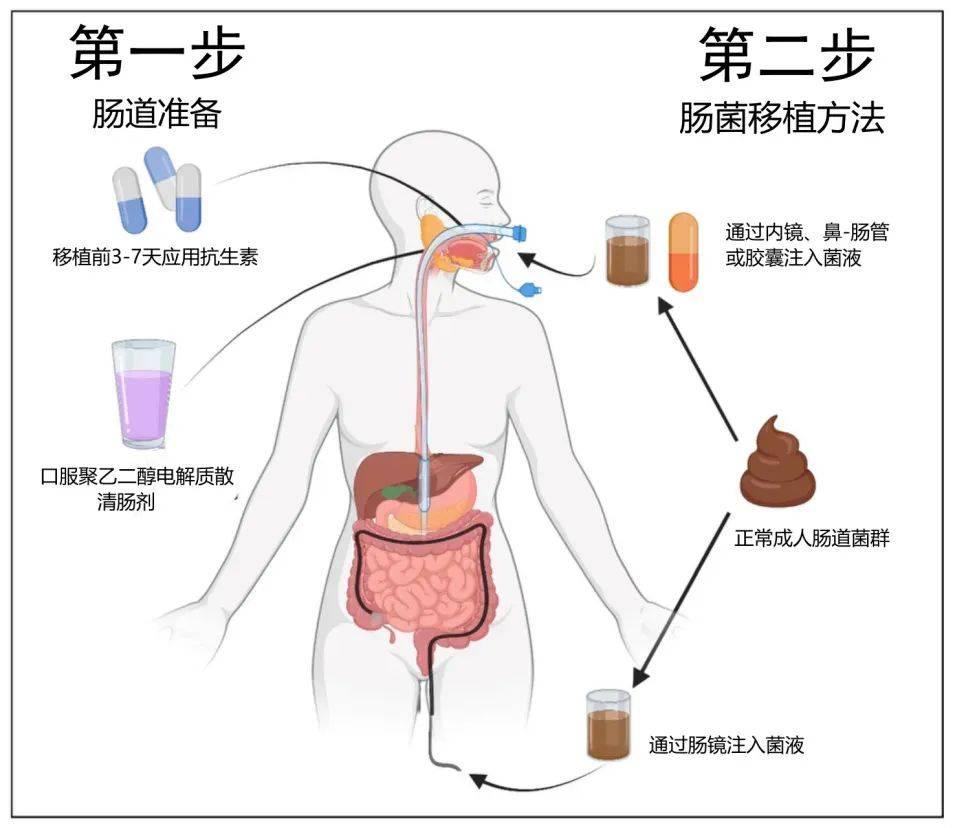 肝性脑病的发病机制图片