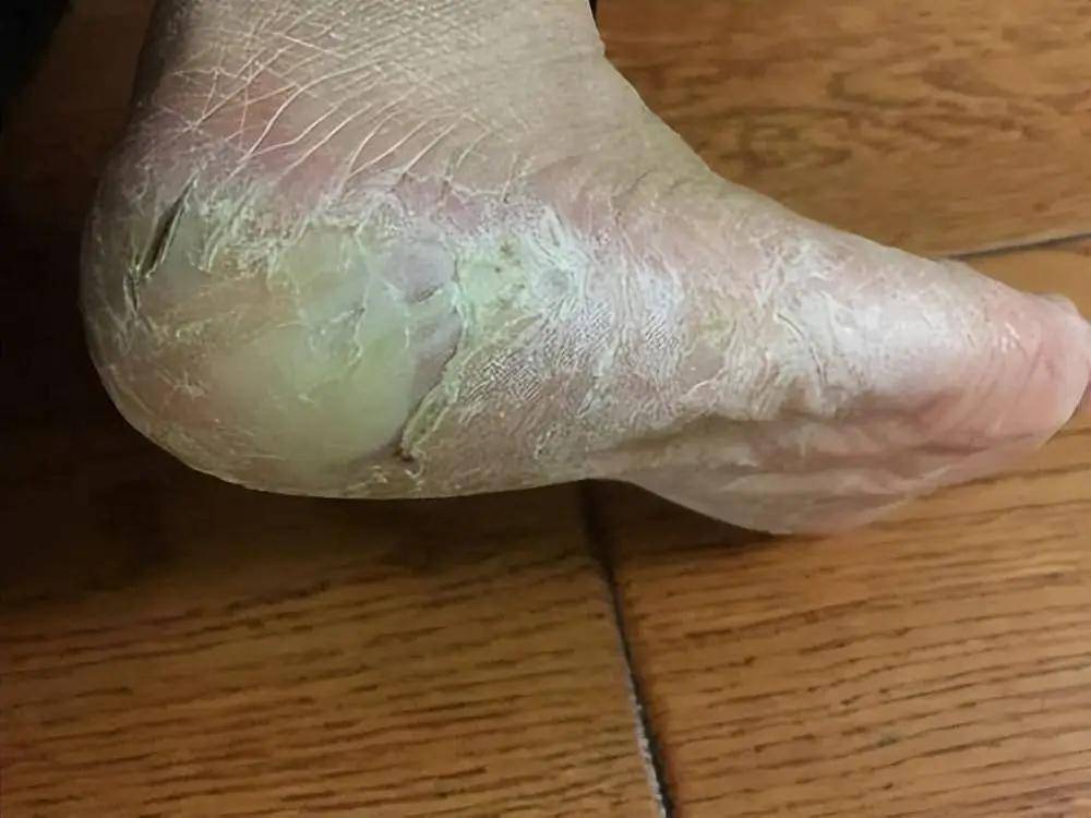 脚后跟干燥瘙痒、渗血怎么办?学会这2招,在家轻松解决!_皮肤_裂口_情况