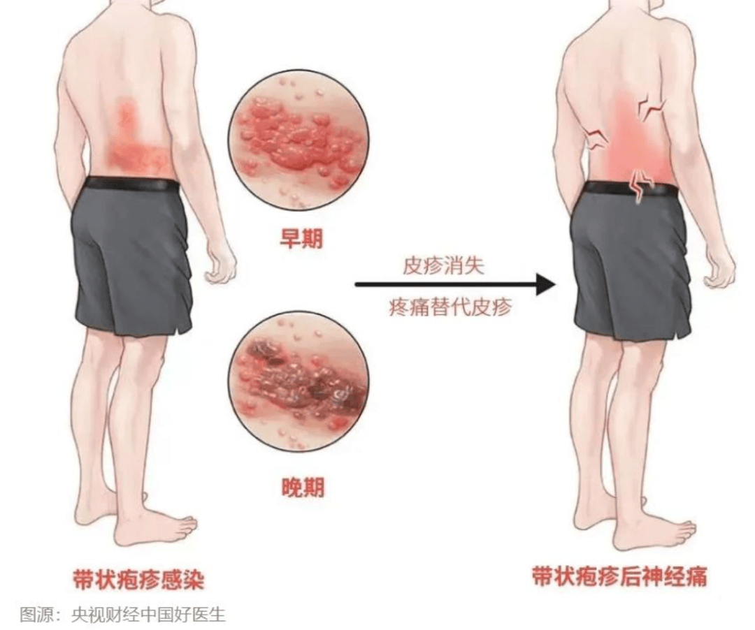 龙须疮图片